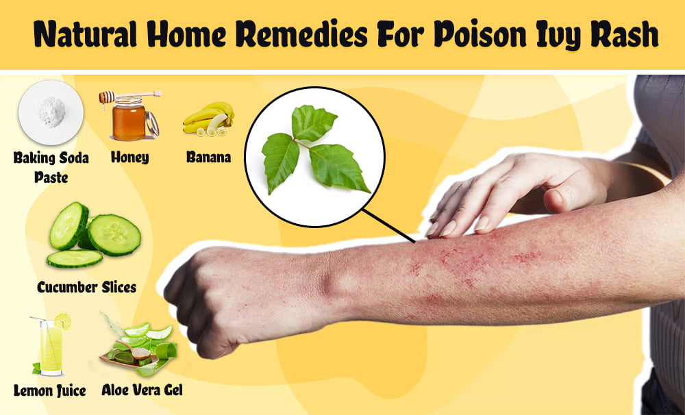 home remedies for poison ivy